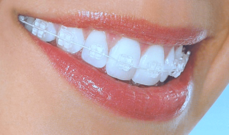 Top Reasons to Invest in Clear Braces: Achieve Your Perfect Smile with Subtle Style