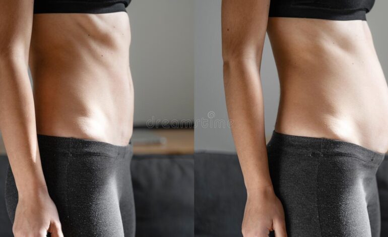 When to Seek Professional Help for Diastasis Recti